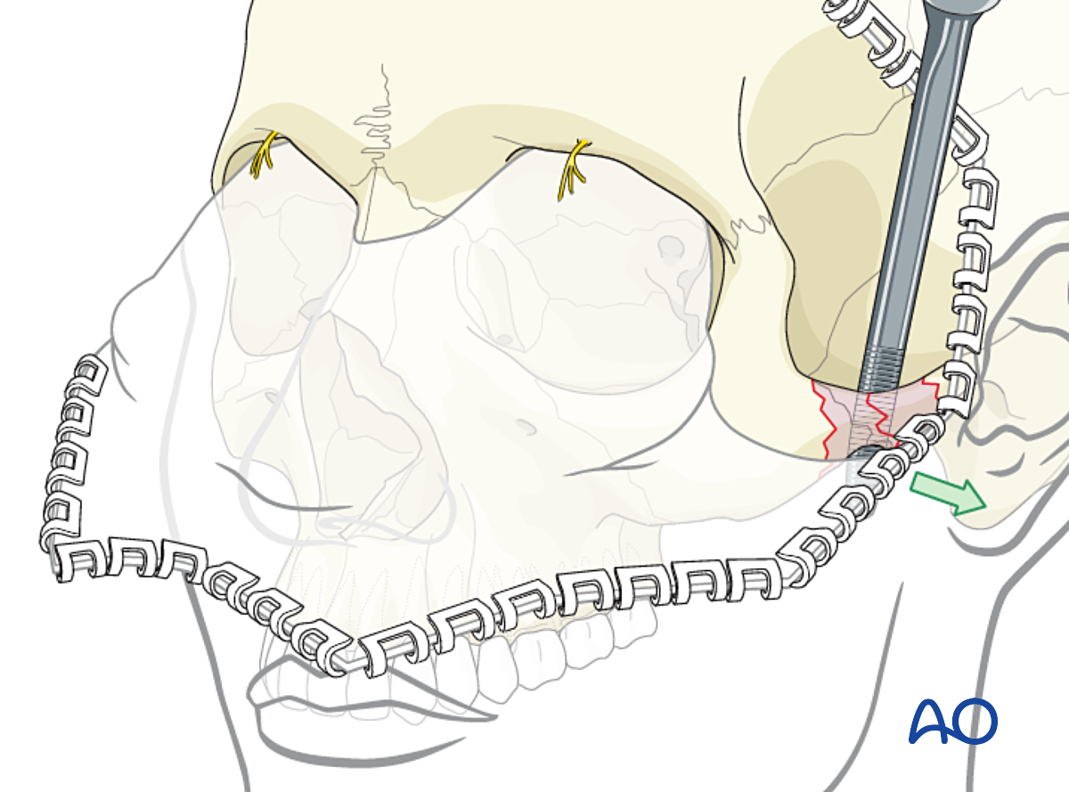Open Reduction With Fixation For Zygoma Isolated Zygomatic Arch Fracture Open Reduction With Fixation For Zygoma Isolated Zygomatic Arch Fracture
