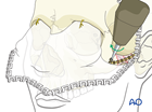 Isolated zygomatic arch fracture