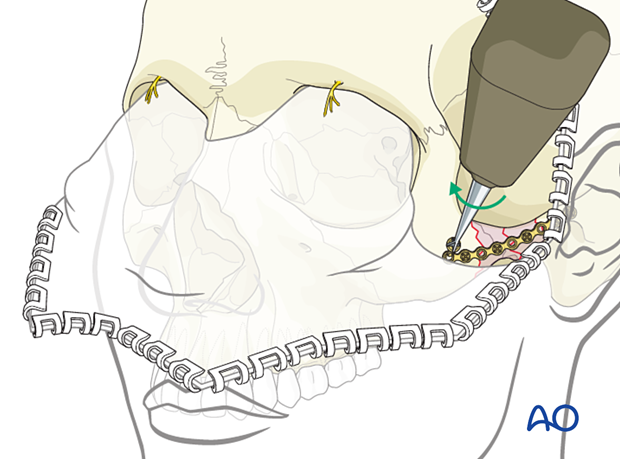 Screw insertion in plate to fix an isolated zygomatic arch fracture.
