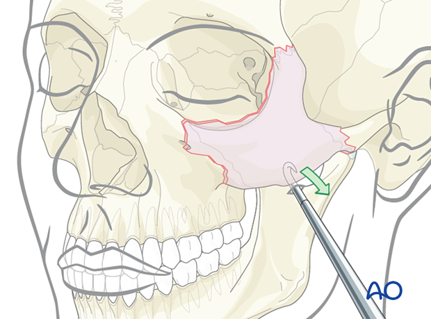 Zygomatic-complex fracture reduction using a bone hook.