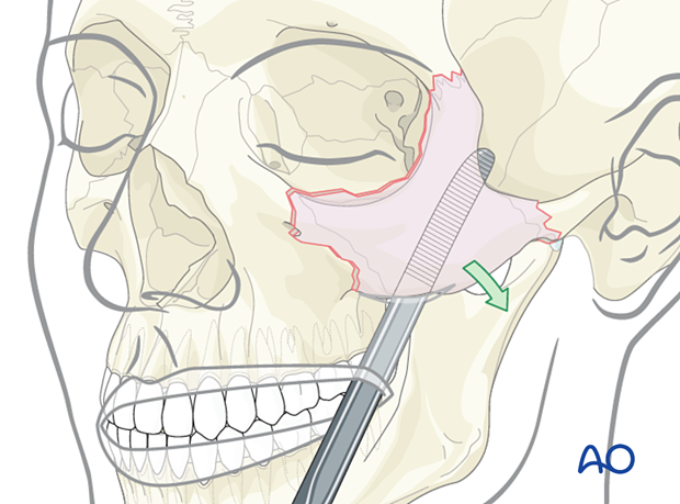 Elevation of the zygomatic arch into its proper position