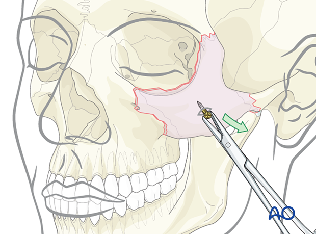closed treatment – a percutaneous or intraoral approach may be used to place a screw into the zygomatic body