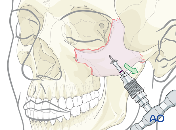 closed treatment - A threaded reduction tool (Carroll-Girard screw) is inserted either percutaneously or intraorally into the body of the zygoma and used for reduction.