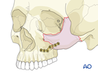 Zygomatic complex fracture 1-point fixation
