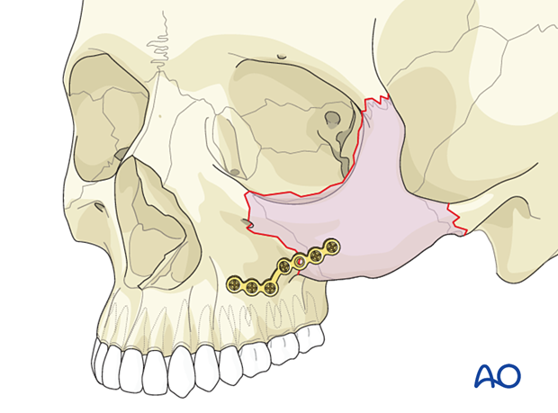 1-point fixation technique of the zygomatic complex using a large L-shaped plate placed on the zygomaticomaxillary buttress.