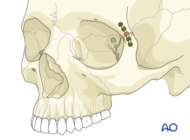 92 P650 ORIF 1 point fixation without orbital reconstruction