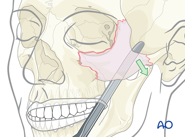 zygomatic complex fracture – ORIF 4-point fixation: reduction