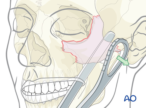 Mobilization and reduction of the zygomatic complex using a Rowe zygoma elevator.