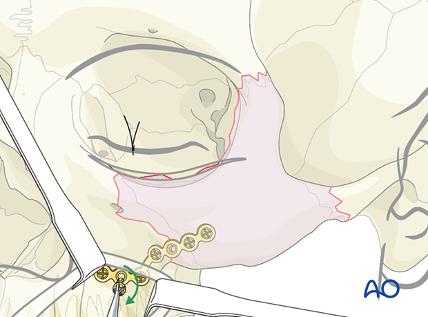 Placement of a thick L-shaped plate – orif 1-point fixation without orbital reconstruction.