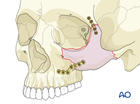 Zygomatic complex fracture