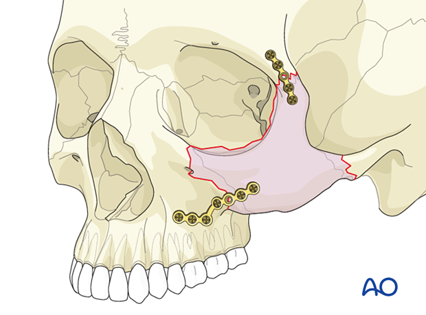 2-point fixation technique of the zygomatic complex using a large L-shaped plate and a curvilinear plate.