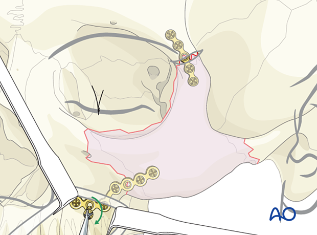 Screw insertion during fixation of the second plate – orif 2-point fixation without orbital reconstruction.