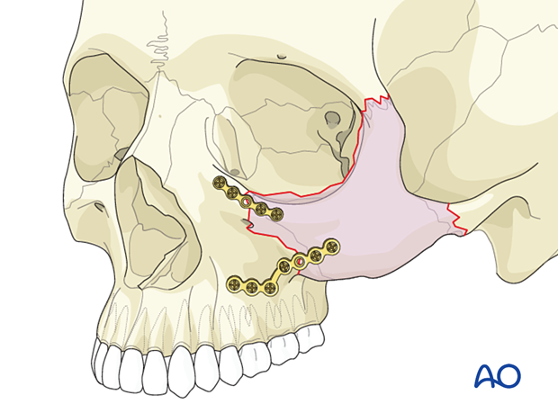 Plate placement for an alternative fracture configuration – orif 2-point fixation without orbital reconstruction