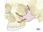 zygomatic complex fracture 3-point fixation 