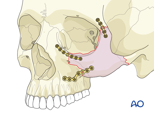 3-point fixation technique of the zygomatic complex using a large L-shaped plate and two curvilinear plates.