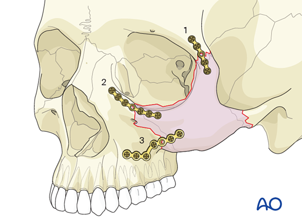 Order of plate placement for the 3-point fixation technique of the zygomatic complex.