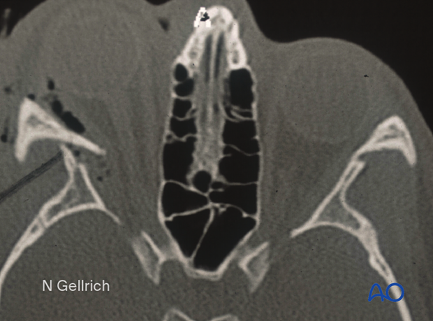 Slice of a CT scan demonstrating contour differences at the lateral orbital wall area.