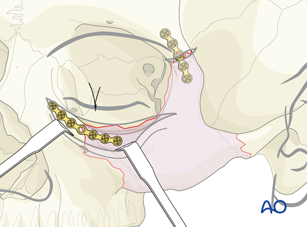 Placement of a 5-hole plate with the extra hole spanning the fracture line – ORIF 3-point fixation without orbital reconstruction.
