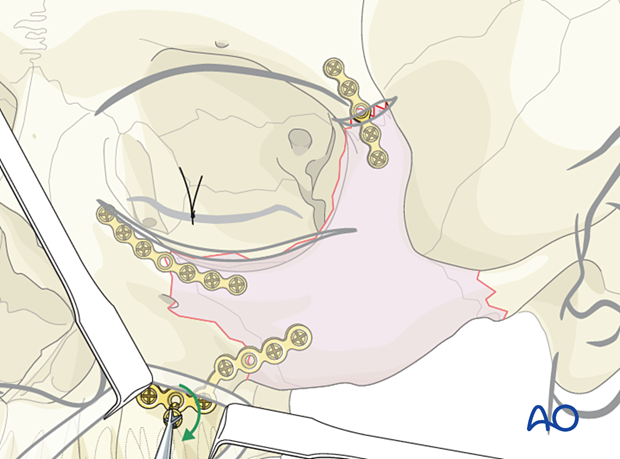 Screw insertion during fixation of the L-plate – ORIF 3-point fixation without orbital reconstruction.