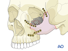 Zygomatic complex fracture