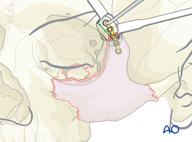 orif 4 point fixation with orbital reconstruction
