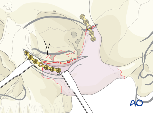 orif 3 point fixation with orbital reconstruction – placement of second plate