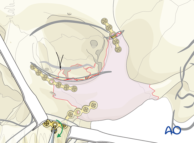 orif 3 point fixation with orbital reconstruction – placement of third plate