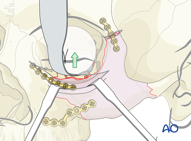 Exposure of the orbital floor defect by using orbital retractors –ORIF 3-point fixation with orbital reconstruction.