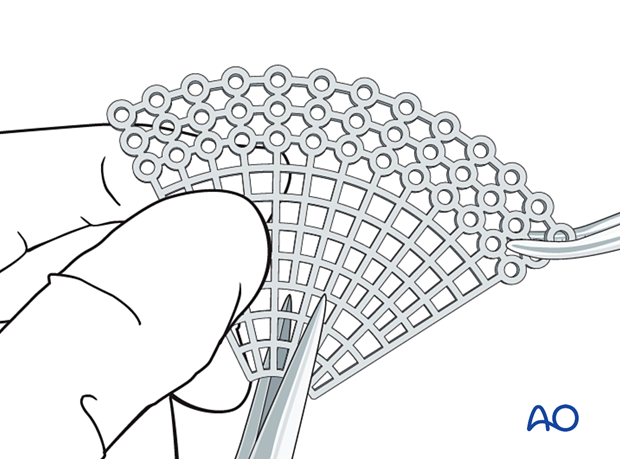 Titanium mesh plate cut to shape for orbital reconstruction.