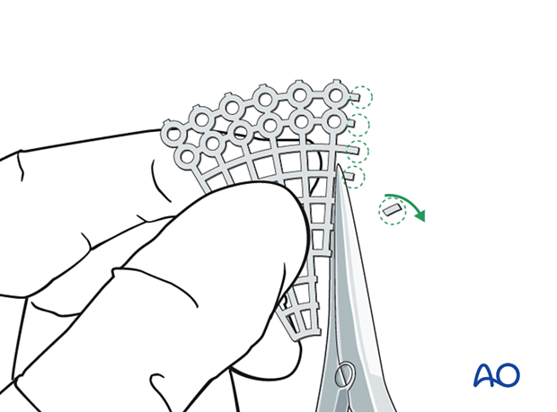 Titanium mesh plate trimmed to protect soft tissues for orbital floor reconstruction.