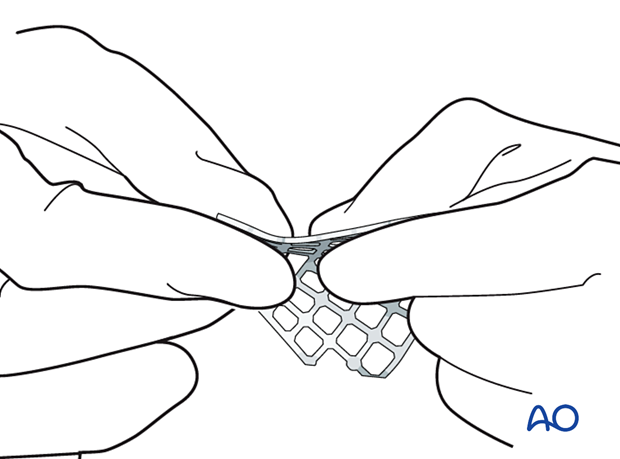 Titanium mesh plate contouring to achieve required shape for orbital reconstruction.