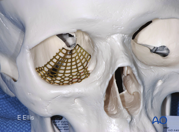 Photograph of the sterile artificial skull showing placement of a titanium mesh plate on the orbital floor.