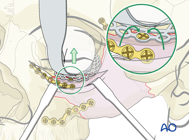 Insertion of the trimmed fan-shaped plate during orbital floor reconstruction.
