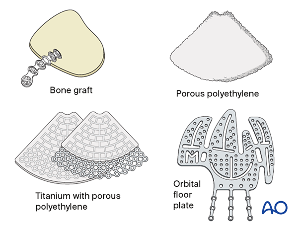 orif 4 point fixation with orbital reconstruction