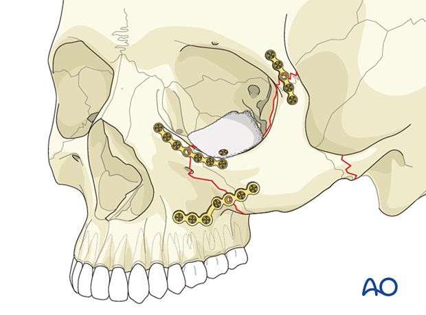 Orbital reconstruction using porous polyethylene – 3-point fixation technique of the zygomatic complex.
