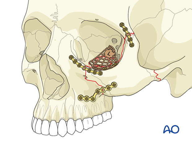 Orbital reconstruction using a preformed implant – 3-point fixation technique of the zygomatic complex.