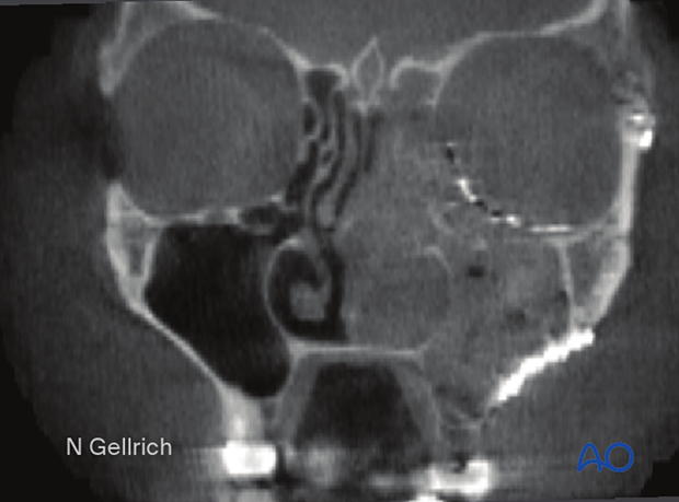 orif 4 point fixation with orbital reconstruction