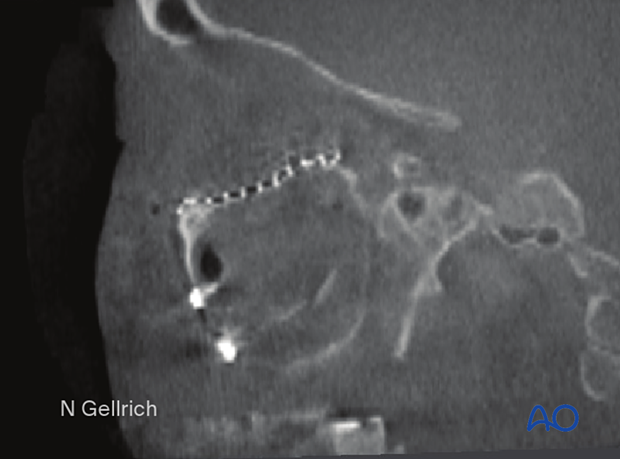 orif 4 point fixation with orbital reconstruction