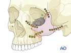 zygomatic complex fracture 4-point fixation