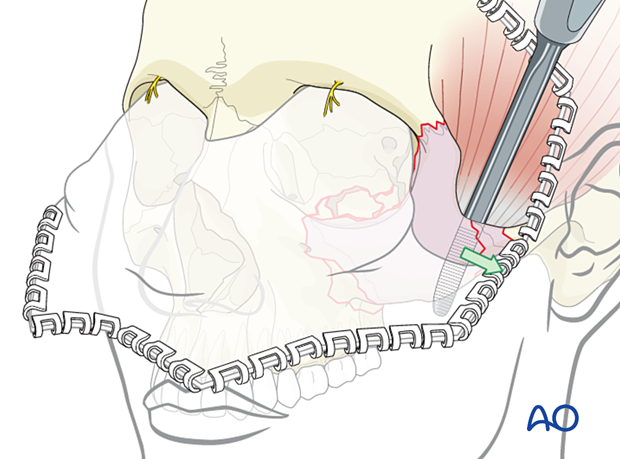 zygomatic complex fracture – ORIF 4-point fixation: reduction