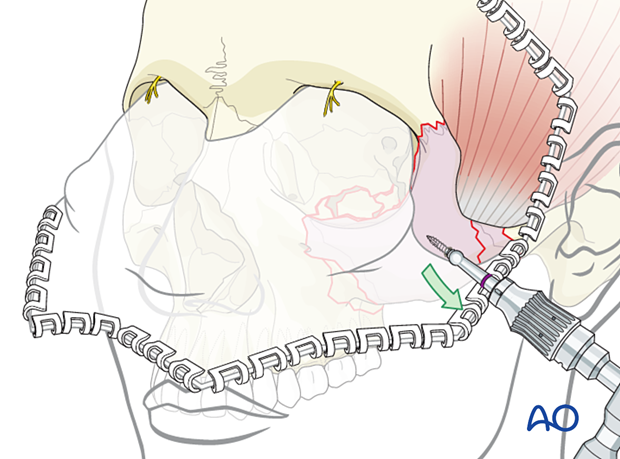 zygomatic complex fracture – ORIF 4-point fixation reduction