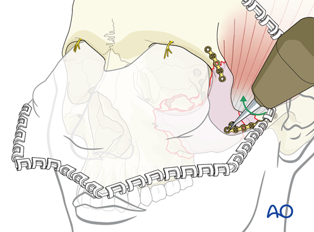 zygomatic complex fracture – ORIF 4-point fixation: placement of additional plates