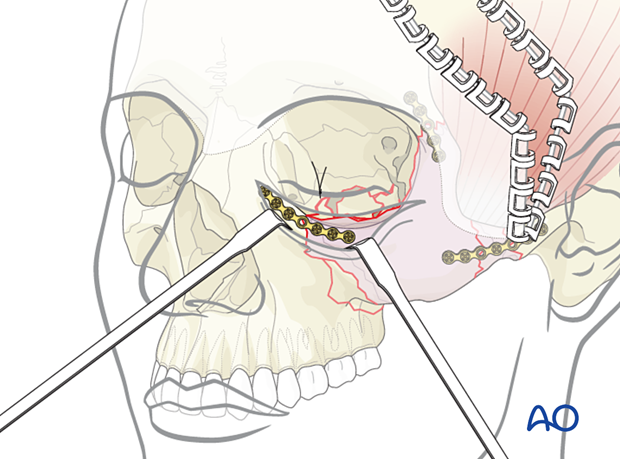 zygomatic complex fracture – ORIF 4-point fixation: placement of additional plates
