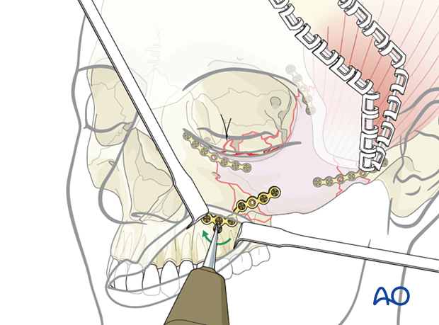 zygomatic complex fracture – ORIF 4-point fixation: placement of additional plates