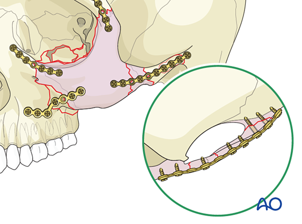 zygomatic complex fracture – ORIF 4-point fixation: placement of additional plates
