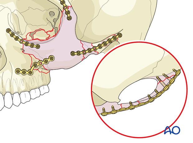 zygomatic complex fracture – ORIF 4-point fixation: placement of additional plates
