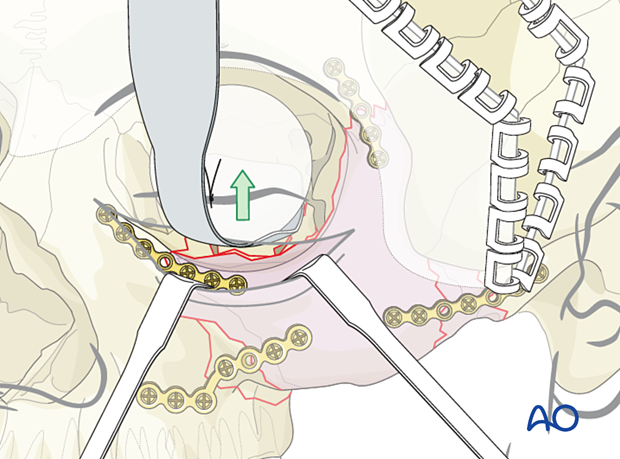 zygomatic complex fracture – ORIF 4-point fixation: reconstruction of the orbital floor defect