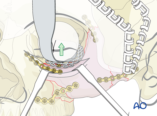 zygomatic complex fracture – ORIF 4-point fixation: reconstruction of the orbital floor defect