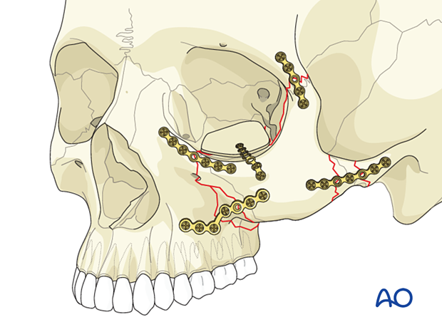 zygomatic complex fracture – ORIF 4-point fixation: reconstruction of the orbital floor defect