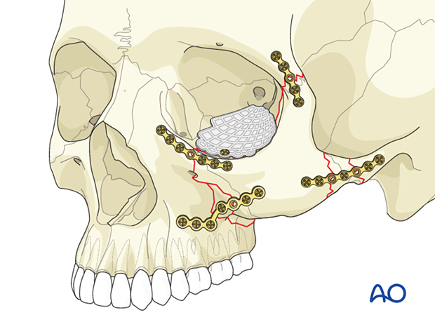 zygomatic complex fracture – ORIF 4-point fixation: reconstruction of the orbital floor defect